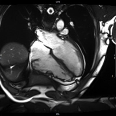 Above and below: Patient with ARCV/D confirmed with CMR. All images courtesy of Dr. Antonio Amadu.