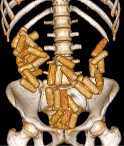 This 3D volume-rendering technique CT image shows numerous large packets of narcotics concealed in a body packer. In a single transport, a body packer can carry 50 to100 packages, each containing 8 g to10 g of narcotic agents, this weighing up to 1 kg in total. Image courtesy of Dr. Mesut Bulakçı.