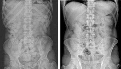 Abdominal x-ray images of packages that contain narcotic materials in solid and liquid forms. Left: A 34-year-old male body packer. In the intestinal lumens, multiple dense packages consisting of powdered cocaine with a scattered formation and ovoid morphology are observed. Right: A 48-year-old male body packer. In the colonic loops, widespread density increments with obscure contours and subtle serpiginous lucencies are observed. Be aware of the fact that contrary to solid drug-containing packages, these types of packages that contain cocaine in liquid form cannot be clearly distinguished. Image courtesy of BJR (April 2016, Vol. 89: 1060, pp. 20150888).