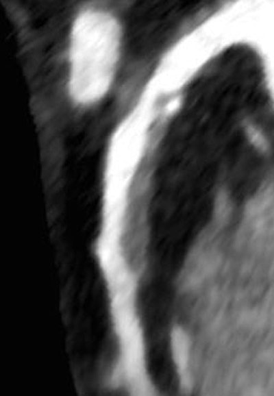 Culprit plaque responsible for subsequent myocardial infarction in the left anterior descending artery. Image courtesy of Stephen Fuller and Dr. Damiano Caruso.