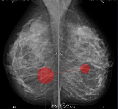 Screenshots of the Tobii eye-tracking software. The radiologists' eye fixations are the red dots. The size of the dot represents the fixation duration time: the bigger the dot, the longer the fixation time. Images courtesy of Wijdan Alomaim.