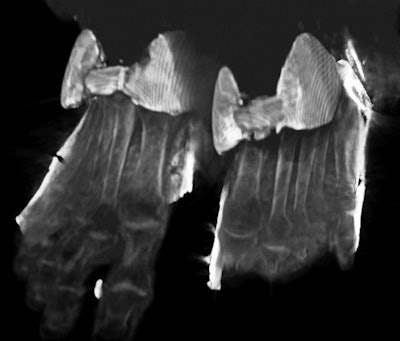 A 3D CT image of the golden sandals worn by Thuya (great grandmother of Tutankhamun) that were hidden beneath her wrappings, a discovery made by Saleem from this CT study.