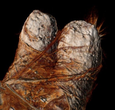 A 3D CT image of the feet of Ramses III: The wrappings are glued with resinous material to hide the injured foot.