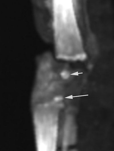 A 2D CT image of the knee of a mummified fetus discovered in the tomb of Tutankhamun and proved to be his daughter by DNA. This CT study was the first ever performed on mummified ancient Egyptian fetuses and is considered a model for any future studies of mummified fetuses. This study estimated the gestational age, gender, and searched for possible anomalies. CT study of the knee of this mummified fetus (assigned as 317b) shows ossified knee epiphyses that helped to estimate an age of 9 months' gestation.