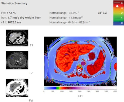 Report produced by LiverMultiScan software indicating patient with LIF score of 3.3, indicating probable liver disease.