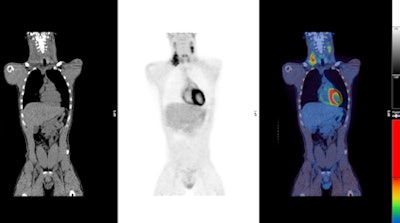PET/CT images show a Hodgkin's lymphoma patient with a negative PET scan after chemotherapy. There is high uptake in lymph nodes on both sides of the neck prior to treatment (above), which resolved after chemotherapy (below). Physiological uptake is also seen in the heart and bladder. Images courtesy of Dr. Sally Barrington, reader in nuclear medicine, PET Imaging Centre at St Thomas' Hospital in London.