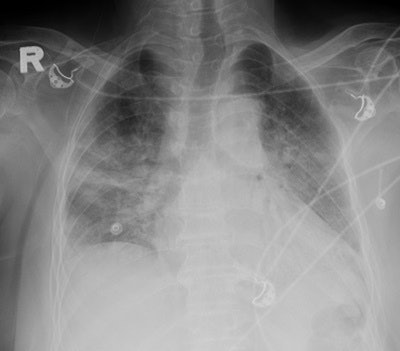 Frontal chest radiograph shows bilateral ground-glass opacities at initial presentation of the disease. All images courtesy of Dr. Karuna M. Das.