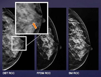 Diagram shows the left breast of the same patient in FFDM, synthesized 2D mammography, and selected DBT slice. There is a well-defined low-density mass noted at the retroareolar region, which was only depicted by DBT but not by FFDM and mammography during image review. Lesion was confirmed to be a fibroadenoma on subsequent ultrasound with fine-needle aspiration performed.
