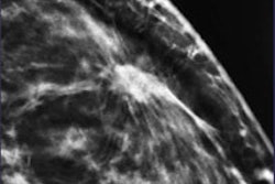 2016 05 03 14 40 47 54 2016 05 03 Dbt Occult Malignancy Thumb