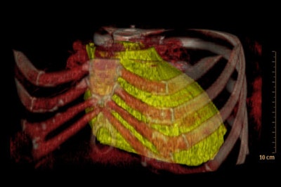 3D reconstruction of epicardial fat volume. Epicardial fat (in yellow) is associated with a higher risk of coronary artery disease.