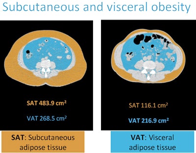 Visceral adipose tissue (VAT) is known to be more dangerous to health than subcutaneous adipose tissue (SAT). In particular, visceral fat surrounding the heart raises the risk of coronary artery disease. All images courtesy of Dr. Zsofia Drobni.