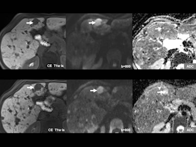 Diffusion-weighted imaging (DWI) can give information beyond that provided by morphological scans. In this case, liver metastasis of a neuroendocrine tumor is shown before (upper row) and after (lower row) therapy. While no change is seen on the contrast-enhanced scans (left), DWI and apparent diffusion coefficient (ADC) (middle and right) show an increase in diffusion that indicates response to therapy. Images courtesy of Dr. Christine Schmid-Tannwald, Ludwig Maximilian University, Munich.