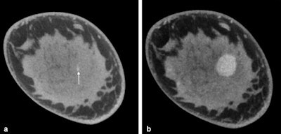 Cone-beam breast CT, contrast-enhanced examination. Each image shows the coronal single slice with invasive ductal breast carcinoma on the right. A: Prior to administering the contrast agent, only dense glandular tissue (ACR IV) and a calcified particle (arrow) in the tumor area. B: After administering the contrast agent, depiction of carcinoma portions with intense contrast agent uptake.