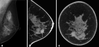Top: Cone-beam breast CT, noncontrast-enhanced examination. Invasive ductal breast carcinoma is visible on the left. A: Digital mammography on the left in MLO projection. B: Breast CT, sagittal single layer with breast carcinoma (arrow) in the caudal breast sections. C: Coronal single slice with depiction of the tumor within the dense glandular breast tissue. Bottom: Cone-beam breast CT, noncontrast-enhanced examination. Mucinous breast carcinoma on the left. A: Sagittal single slice. B: Maximum intensity projection (MIP) of the dataset with breast carcinoma in the caudal breast sections. C: Reconstructed image with depiction of the surfaces of the intramammary structures and the tumor (arrow).