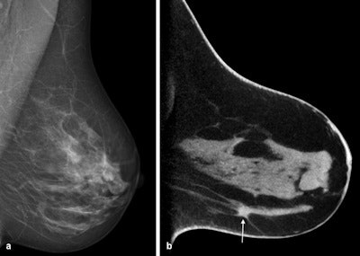 Cone-beam breast CT, noncontrast-enhanced examination. Invasive ductal breast carcinoma is shown on the left. A: Digital mammography on the left in mediolateral oblique (MLO) projection. B: Breast CT, sagittal single slice with depiction of breast carcinoma (arrow) in the caudal breast sections.