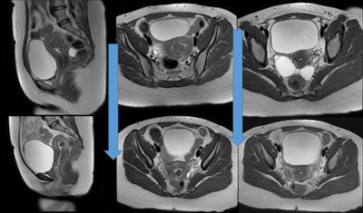 MR images before and four months post UFE in a 32-year-old patient with a 5-cm submucosal fibroid. The patient's symptoms of pelvic pain and menorrhagia resolved one month post UFE. MRI showed significant reduction in the size of the submucosal fibroid and disappearance of ovarian cysts. This patient became pregnant six month post UFE.