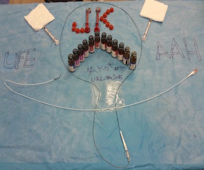 The usual tools used for UFE: Robert catheter, microcatheter, and embolization particles.