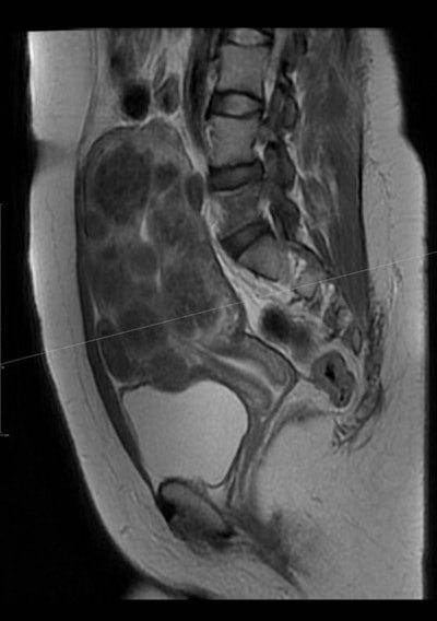 MR image of the uterus in a 29-year-old woman showed multiple uterine fibroids in all locations, which was impossible to resect totally by surgery. This was an ideal UFE patient to save the uterus and fertility. Patient became pregnant 12 months after undergoing UFE.