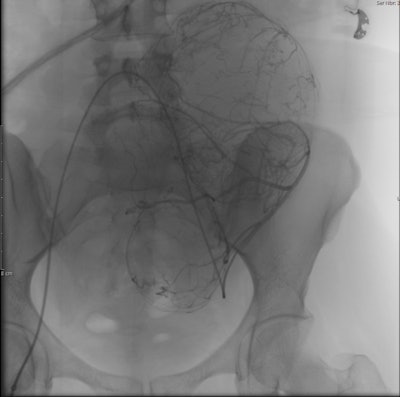 Left uterine fibroid embolization in progress.