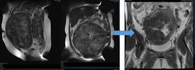 Abdominal MR images showed a 30 x 20-cm single fibroid in a 34-year-old woman with severe menorrhagia and anemia. She was offered hysterectomy, but she opted to undergo UFE, which was successful in reducing the size by 60% and controlling her symptoms.