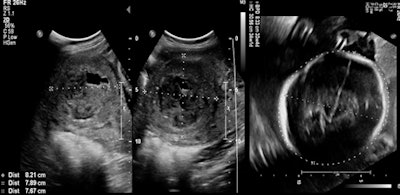 Patient who became pregnant eight months post UFE. Obstetric third-trimester ultrasound images of a single fetus at age of 31 weeks 1 day and also at 34 weeks 1 day by last menstrual period (LMP). The previously embolized fibroid now measured 8.2 x 7.8 x 7.6 cm with degenerative changes. Placental localization is anterior with normal amniotic fluid. She delivered a full-term healthy baby by cesarian section.