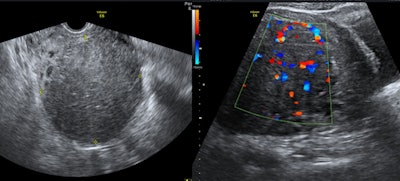 A 34-year-old woman presented with menorrhagia for nine days. The patient also had rheumatic mitral valve stenosis. Ultrasound scan of the uterus before embolization showed a 10 x 8-cm uterine fibroid with tense vascularity, which was treated by UFE. All images courtesy of Dr. Jamal Alkoteesh.