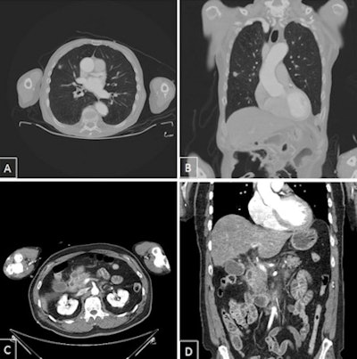 Secondary findings of category 1. A and B: Polytrauma CT with coronal multiplanar reconstruction; lung lesion on the right is suspicious for malignancy. Suspicious for peripheral bronchial cancer. C and D: Polytrauma CT with coronal multiplanar reconstruction. Acute exudative pancreatitis.
