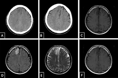 Low-grade malignant astrocytoma. Secondary finding of category 1 -- low-grade malignant astrocytoma. A and B: Axial noncontrasted CT, extensive hypodensity in right frontal region adjacent to the interhemispheric fissure. C: T1-weighted spin echo axial noncontrasted, hypodense lesion corresponding with noncontrasted CT. D and E: Fluid-attenuated inversion recovery (FLAIR), T2-weighted spin echo axial, signal alteration of the lesion. F: T1-weighted spin echo axial after gadolinium-containing contrast agent, no enrichment.
