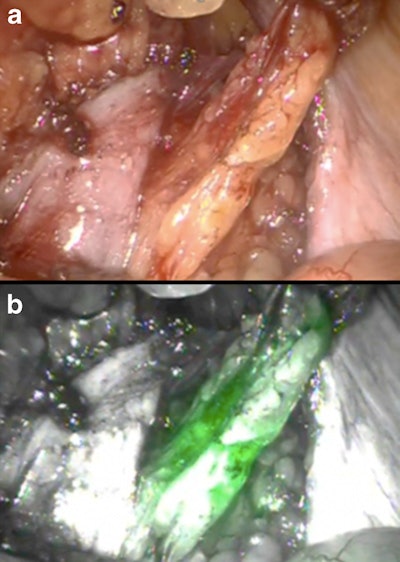 Fluorescence-based images show locations of sentinel nodes and lymph nodes (a and b) detected intraoperatively inside and outside the extended pelvic lymph node dissection area (green in vivo fluorescent sentinel nodes, yellow ex vivo identified sentinel node). Images courtesy of EJNMMI.