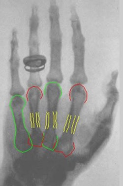 X-ray of 78-year-old patient (von Kölliger) acquired by Conrad Röntgen on January 23, 1896. The image was analyzed with the DXR method, yielding a metacarpal index of 0.64, which translates into a Z score of 2.4. Image courtesy of Hans Thodberg, PhD.