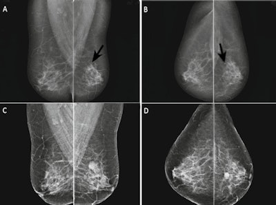 Patient example, repeated recall after previous false-negative recall. Two-view mammogram (A: mediolateral oblique view; B: craniocaudal view) at first recall in 2009 shows a round mass with obscured margins, located dorsally in the left breast (arrows). Ultrasound showed a 4.5-mm mass, interpreted as a simple cyst, and the lesion was classified as BI-RADS 2. Two years later the woman was recalled again because of an increased size of the mass (C, D), and ultrasound now showed a complex cyst of 14 mm. Pathology revealed an invasive ductal carcinoma and intraductal papillary carcinoma without axillary metastasis. Image reprinted with permission from European Radiology.