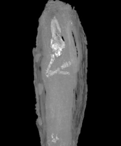 Micro CT of the upper limbs and skull of the fetus. Image copyright Fitzwilliam Museum, Cambridge.