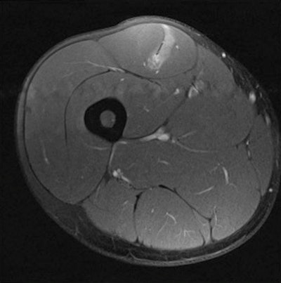 Axial fat-suppressed image demonstrates a muscle tendon junction injury to rectus femoris. Image courtesy of Dr. Steve James.