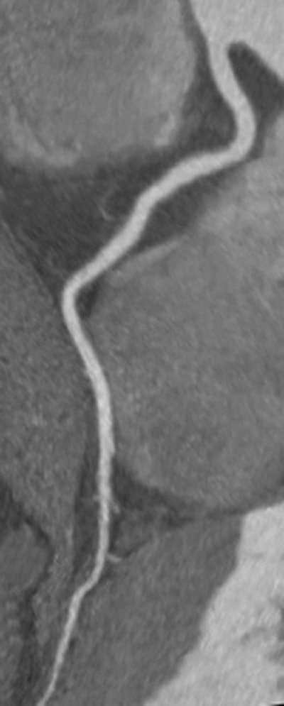 CCTA of a right coronary artery without stenosis or artifacts, imaged with iobitridol 350 mg iodine/mL. Image courtesy of Dr. Stephen Achenbach.