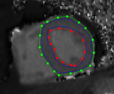 Midventricular short axis native T1 map. Endocardial (red line) and epicardial (green line) contours, as well as the region of interest for the calculation of the average myocardial T1 value (area between the blue lines) can be seen. Republished with permission of PLOS One.