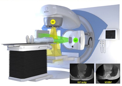 Deep inspiration breath-hold with ultrafast kVMV cone-beam CT guidance.