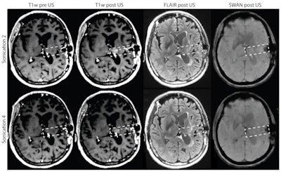 MR images from patient 15, who had a grade 3 BBB disruption in four of four sessions, show no evidence of tumor progression and a slight reduction in the fluid-attenuated inversion recovery (FLAIR) signal after four months on the study. Credit: A Carpentier et al, Science Translational Medicine (2016).