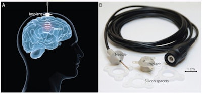 The implantable ultrasound device. (A) The device is fixed in the skull bone and connected to an external power supply by a transdermal needle connection during activation. (B) The implant comprises an ultrasound transducer encased in a biocompatible housing. The implant is passive and is connected by a transdermal needle to an external radiofrequency generator at each treatment to disrupt the BBB. Credit: A Carpentier et al, Science Translational Medicine (2016).