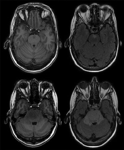 MRI brain scan shows a progressive lesion in the pons of a 50-year-old woman during two years of follow-up. T1-weighted sequence (top left) and a fluid-attenuated inversion recovery sequence (top right) find a subtle lesion in the pons. The same sequences (bottom row) of the MR exam two years later find the lesion expanded greatly. The final diagnosis was high-grade glioma of the pons. Despite radiation therapy, the patient died within 30 months of the initial examination. Images courtesy of Radiology.