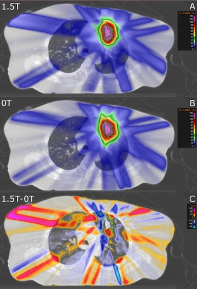 Transversal CT slice of a lung cancer patient overlaid with the simulated dose accumulated on the reference 4D CT phase with a 1.5-tesla magnetic field present (A), the delivered dose without a magnetic field (B) and the difference between those two distributions (C). The GTV is contoured in dark green and the ITV + 5 mm is contoured in light green. Credit: Menten et al/Elsevier.