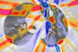 2016 07 07 12 16 20 740 2016 07 08 Medphysweb M Rg Rt Lung 20160707191714