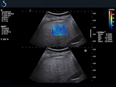 Fatty liver with shear-wave elastography shows stage F3 liver fibrosis.
