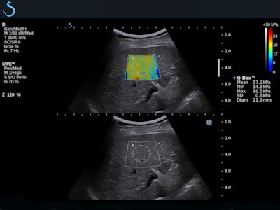 Shear-wave elastography demonstrates stage F4 liver fibrosis.