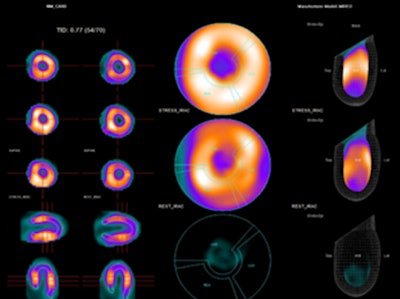 SPECT MPI study is positive for ischemia in a woman with a very low calcium score, no signs of ischemia in her ECG, and no previous myocardial infarction. Image courtesy of Dr. Samia Massalha.
