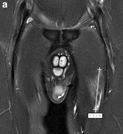 Continuous measurements of edema in acute lesions. Above: Coronal proton density-weighted fat-suppressed image shows proximal distal extent of edema in an adductor longus lesion. Below: Corresponding axial proton density-weighted fat-suppressed image shows extent of edema in the anteroposterior and mediolateral directions. Bottom: Axial proton density-weighted fat-suppressed image shows a measure of the maximum thickness of perimuscular fluid-equivalent signal (double-headed arrow). All images courtesy of European Radiology.