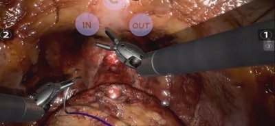 Simulated robotic radical prostatectomy, freehand urethrovesical anastomosis performed on a RobotiX Mentor console (Simbionix). YouTube videos of surgery are available here, here, and here.
