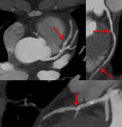 Cardiac dual-energy CT study in progress evaluates the potential of increasing coronary CT angiography's (CCTA) specificity by combining anatomic imaging and myocardial rest iodine distribution. Above, stenosis in intermediate left anterior descending (LAD) artery on morphologic CCTA images. Below, minor iodine distribution within distal LAD territory is a sign of hemodynamic significance of the lesion. Images courtesy of Dr. Thomas Henzler.
