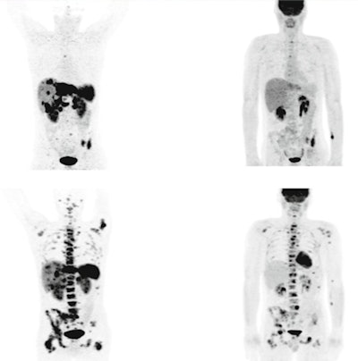 PET images show a 32-year-old man with a grade 2 neuroendocrine tumor in the pancreatic tail. There were positive Ga-68 DOTATOC PET and FDG-PET results in both initial scans and during follow-up, which indicated disease progression. Images courtesy of EJNMMI.