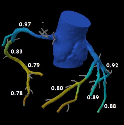 Coronary CT angiography revealed stenosis > 50% in a mid-40s man with atrial fibrillation. However, FFR-CT showed no flow restrictions (depicted in blue) in the area surrounding the calcifications, only minor flow restrictions (yellow and red) in the distal arteries, enabling the patient to be managed conservatively. Image courtesy of Dr. Koen Nieman.