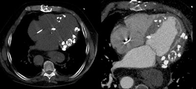 Patient scheduled for aortic valve replacement was found to have significant calcification in the myocardium of unknown etiology.